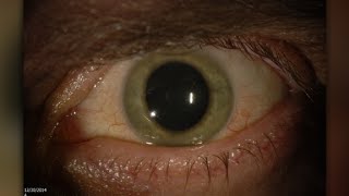 Doctor finds Ebola virus in his eye