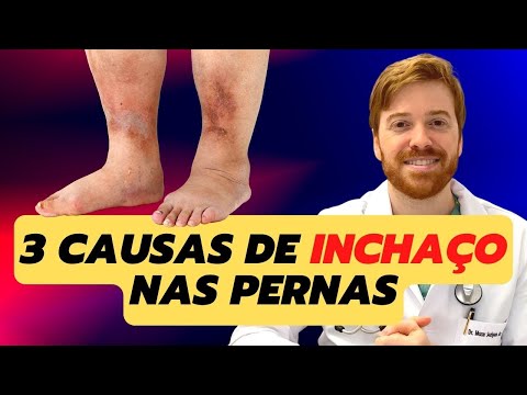 Common causes of leg swelling!