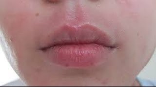 How to get rid of Perioral Dermatitis