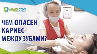 Лечение кариеса между зубами. 👄 Современные технологии при лечении кариеса между зубами. 12+