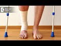 How to heal a broken bone faster? - Dr. Hanume Gowda