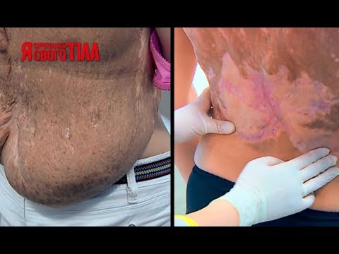 Синие темные пятна под кожей на Отбеливание лица результат