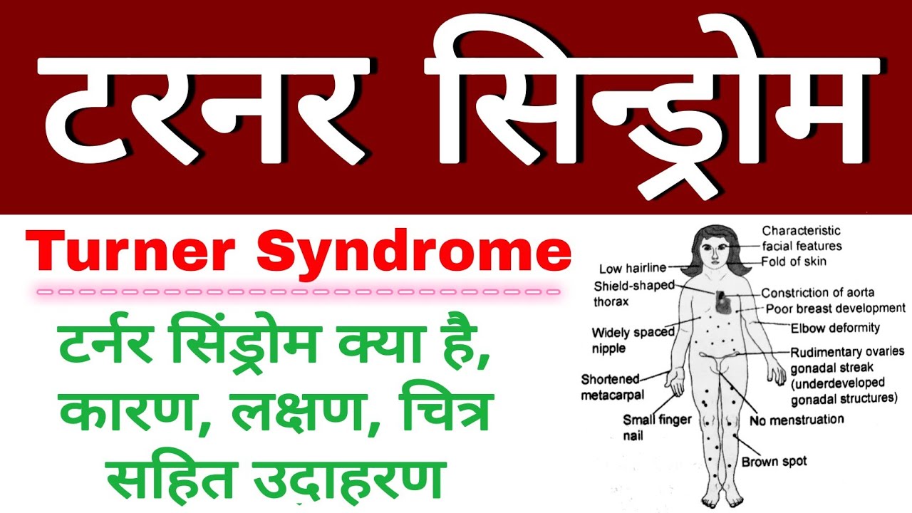 Turner Syndrome In Hindi