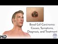 Basal Cell Carcinoma Causes Symptoms Diagnosis And Treatment