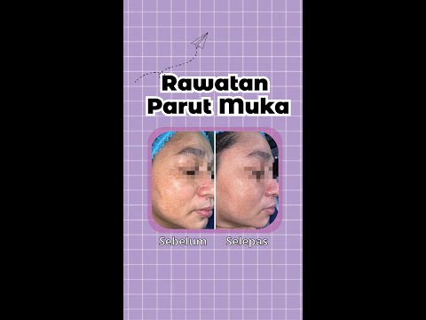 Face Scars ⚡️ PicoWave Treatment ⚡️