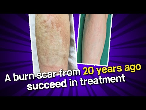 A burn scar from 20 years ago. succeed in treatment