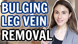 Leg vein removal: varicose veins & spider veins | Dermatologist @Dr Dray