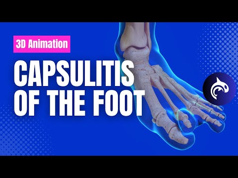 Achilles Tendon Rupture and Repair 3D Animation
