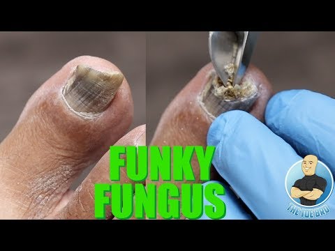 Ciuperca unghiilor și simptomele picioarelor