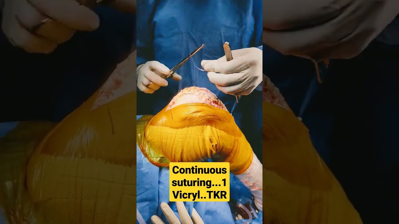 Continuous suturing...1 Vicryl..TKR..Dr Sai Chandra