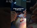 Quick View Of A Gland Extraction By Dr Castañeda Gynecomastia Gynecomastiasurgery Plasticsurgery