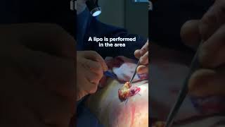 Quick view of a gland extraction by Dr.Castañeda #gynecomastia #gynecomastiasurgery #plasticsurgery