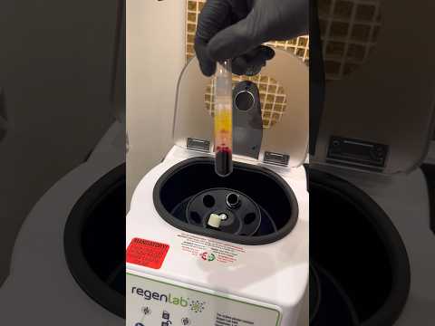 PRP which is Platelet Rich Plasma mixed with 40mg of Hyaluronic Acid #prp #hyaluronicacid #drsknn