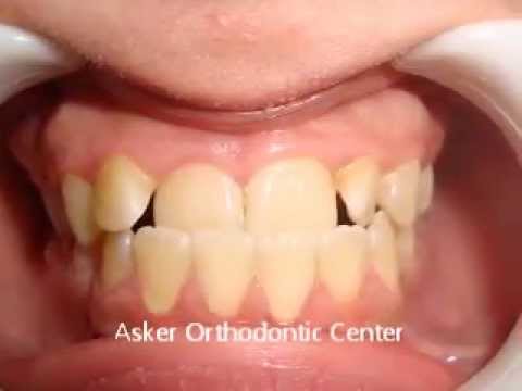 Case Report of Orthodontic Pseudo class III