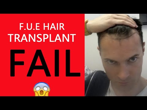 My Disaster FUE Hair Transplant Failed! FARJO HAIR...