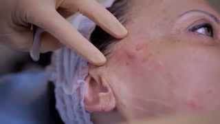 Lifting du visage sans chirurgie - Consultation avec le Dr Rajaonarivelo