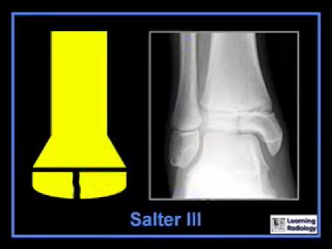 LearningRadiology 06 (Salter-Harris Classification)