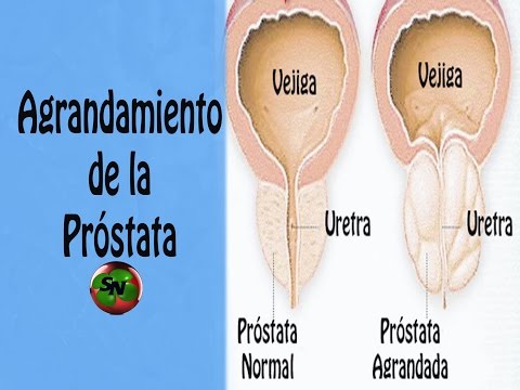 Gießen kaltes Wasser chronische Prostatitis Was zu tun ist, das war so nicht die Prostata