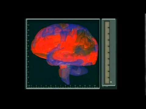Ted Talks - A look into the brain using fMRI for chronic pain patients