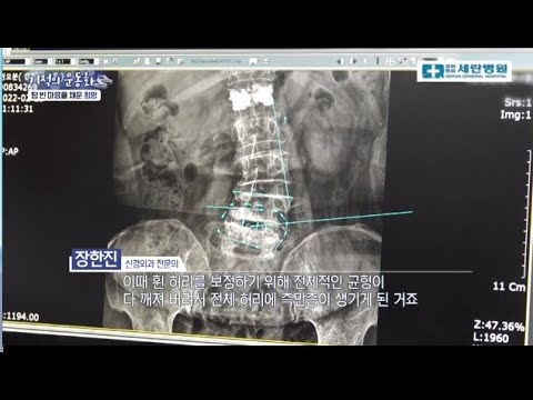 [기적의 운동화] 굽어버린 어머니의 허리, 수술 후 곧게 될 수 있을까요?