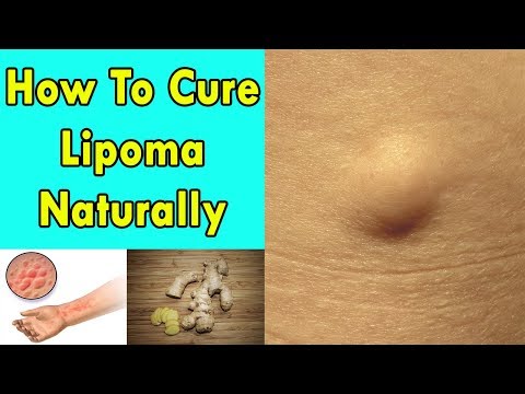 How To Cure Lipoma Naturally | How To Get Rid of Lipomas at Home | Lipoma Treatment Without Surgery