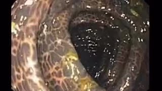 长期喝减肥茶，通便茶或者酵素，你的肠管可能会变成这样的“豹纹