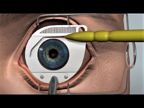 LASIK eye surgery - 3D animation