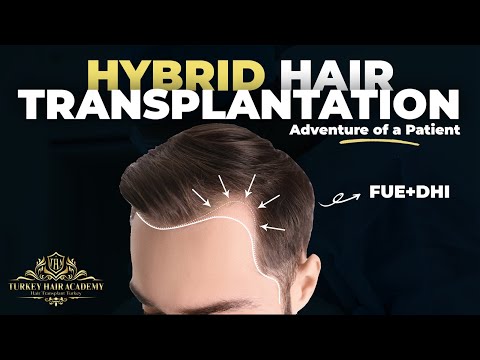 FUE + DHI Hair Transplantation Operation Process (Adventure of a Patient)