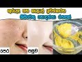 use-this-remedy-to-cure-your-pimples-03-08-2019