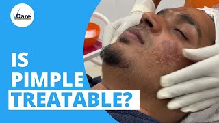 VCare Salicylic Peel – Looking For A Permanent Result For Pimple