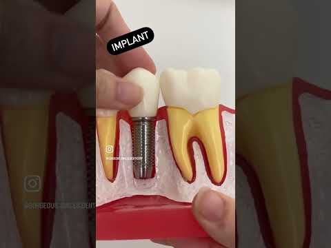 How To Replace A Missing Tooth?