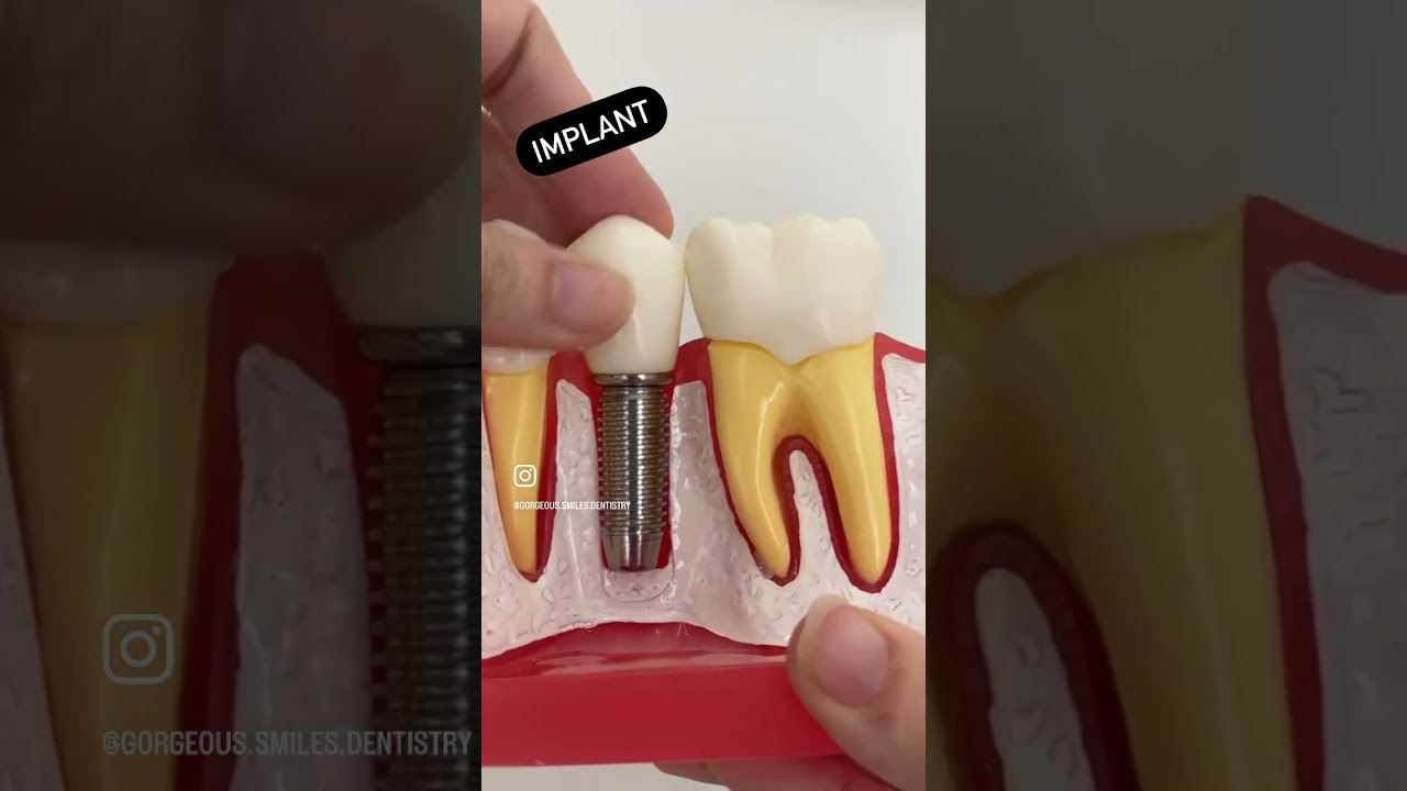 How To Replace A Missing Tooth?