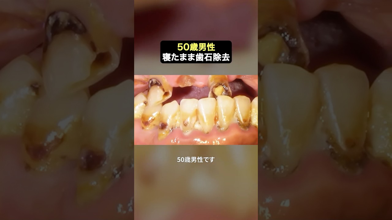 超スッキリ大量歯石除去　#ザホワイトデンタルクリニック  #歯医者  #歯石除去