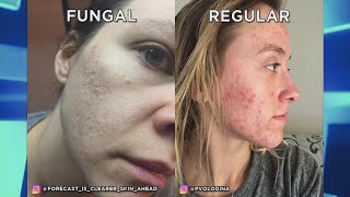 How is Fungal Acne Different Than Traditional Acne? video