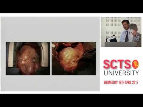 Bleeding & Factor VII