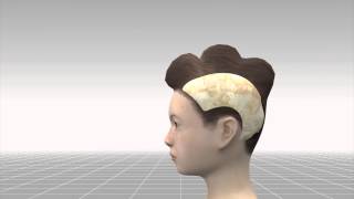 Extreme surgery: girl has balloons inserted under her scalp to prevent cancer