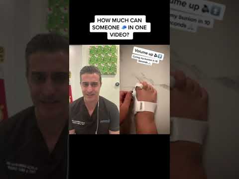 Unbelievable Trend: People Faking Bunions!