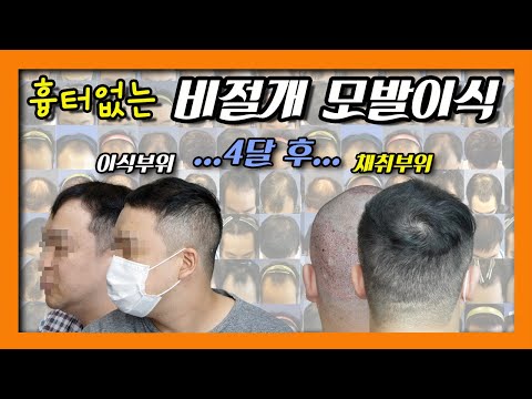 [비절개모발이식]헤어라인&정수리 탈모 모발이식 4개월 경과 리얼후기 전후사진