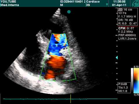 Valvulopatía mitral en el examen ecográfico