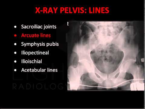 Emergency X-Ray Interpretation of the Pelvis