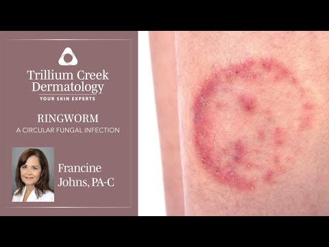 What is ringworm and how is it treated?