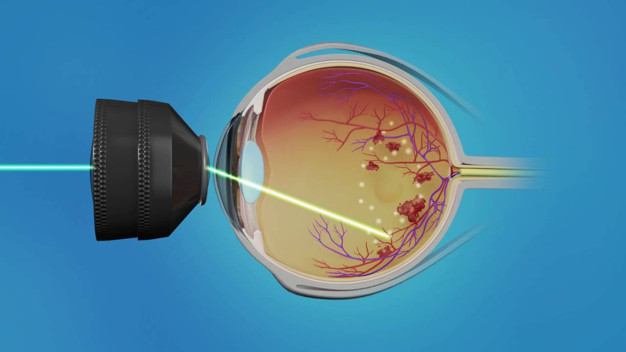 Medication Injection and Laser Surgery for Macular Edema