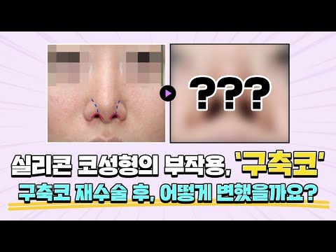 실리콘 코성형의 대표적인 부작용 "구축코", 재수술로 해결할 수 있습니다 ✔️