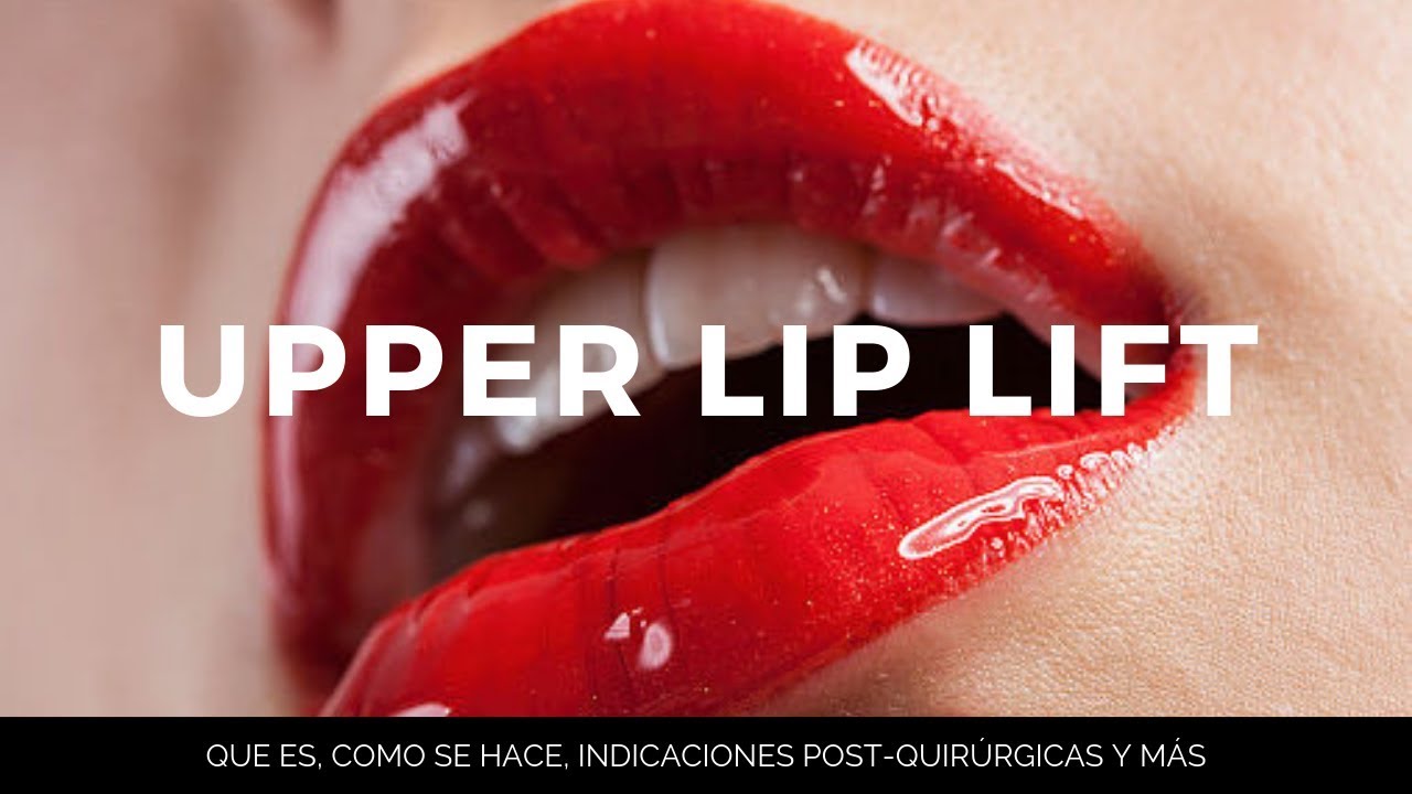 TODO SOBRE UPPER LIP LIFT + antes & después