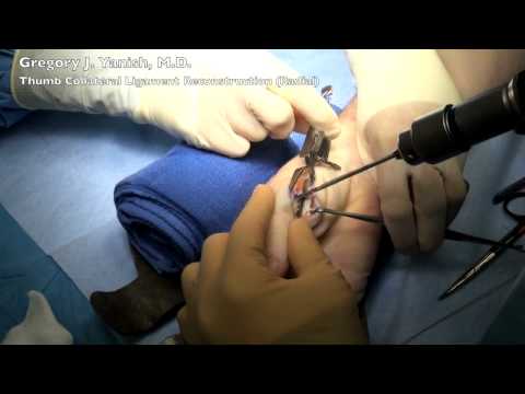 Rekonstrukcja więzadła pobocznego promieniowego kciuka w stawie śródręczno-paliczkowym 
