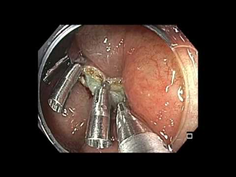 Colonoscopy: Cecal EMR - APC - Clips - Details