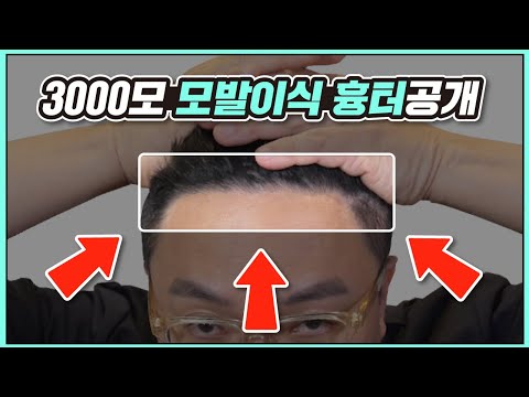 최초공개! 절개식 모발이식 흉터공개! 만족도? 생착률?