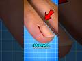 Have You Ever Wondered What Happens If You Rip a Hangnail?