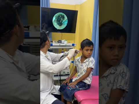 Doctor Removes Giant Earwax Blockage! 😱👂 #ENT #EarCare #Doctor