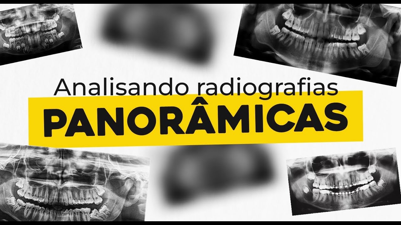 Analisando radiografia panorâmica | RADIOLOGIA